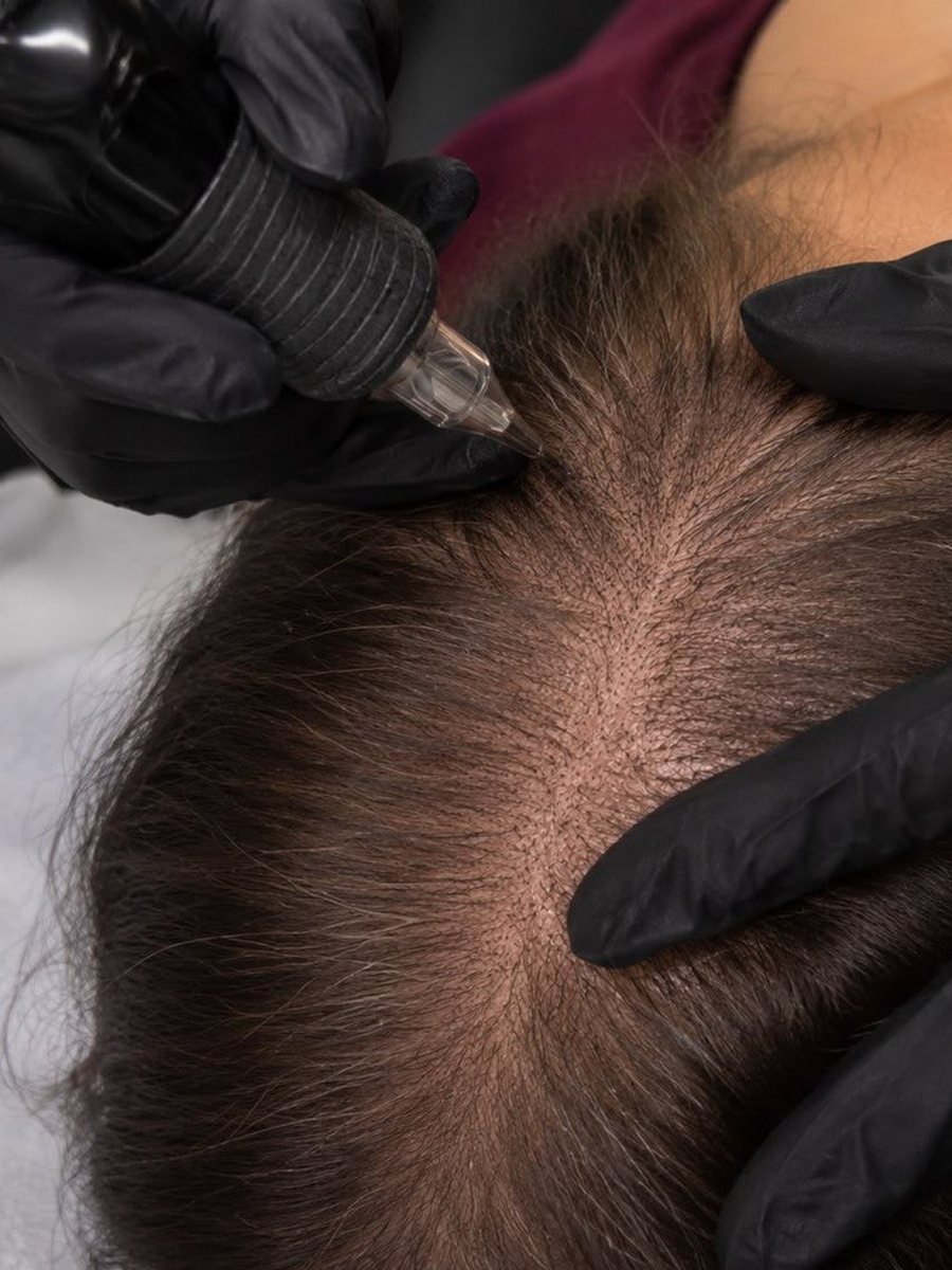 Hair Restoration — SMP