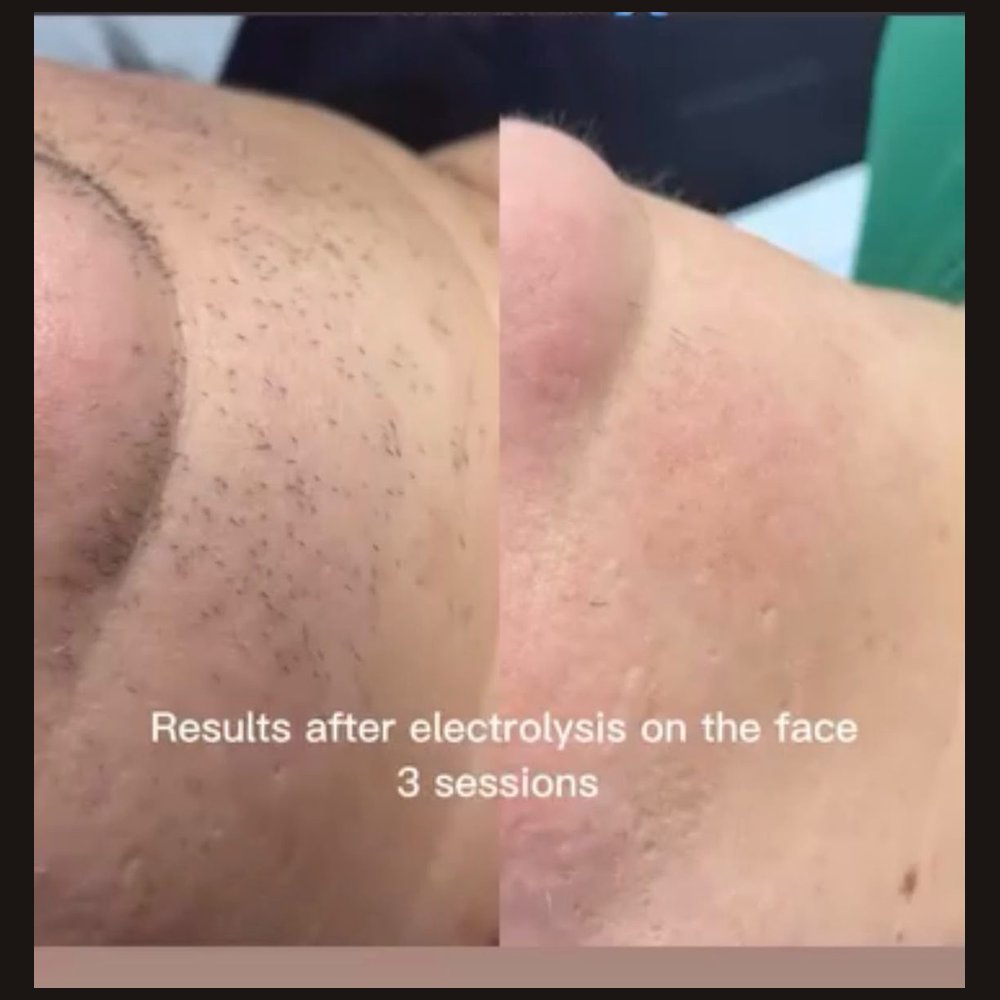 Facial electrolysis — the result after three sessions