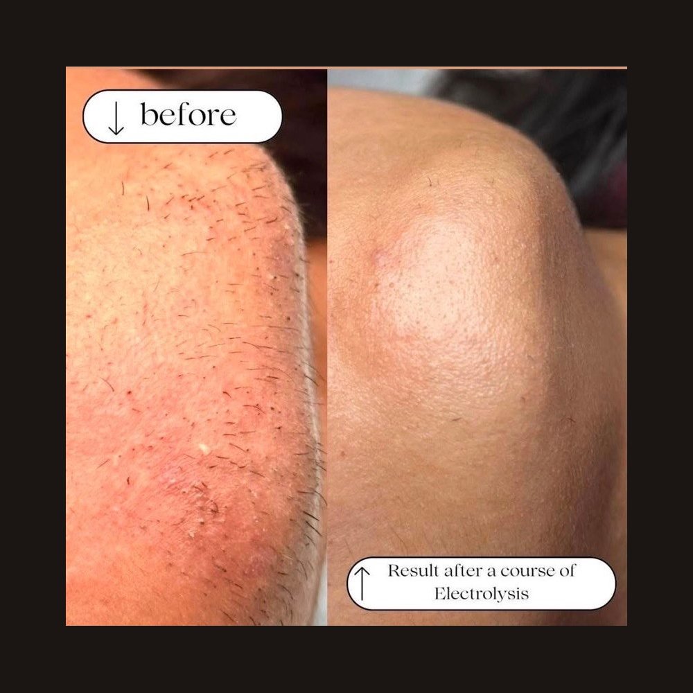 Electrolysis after 15 sessions: the client had tried every hair removal method, only this one worked