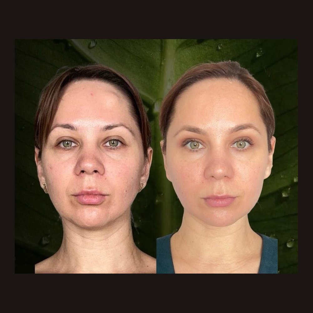 Facial sculpting — before and after a course