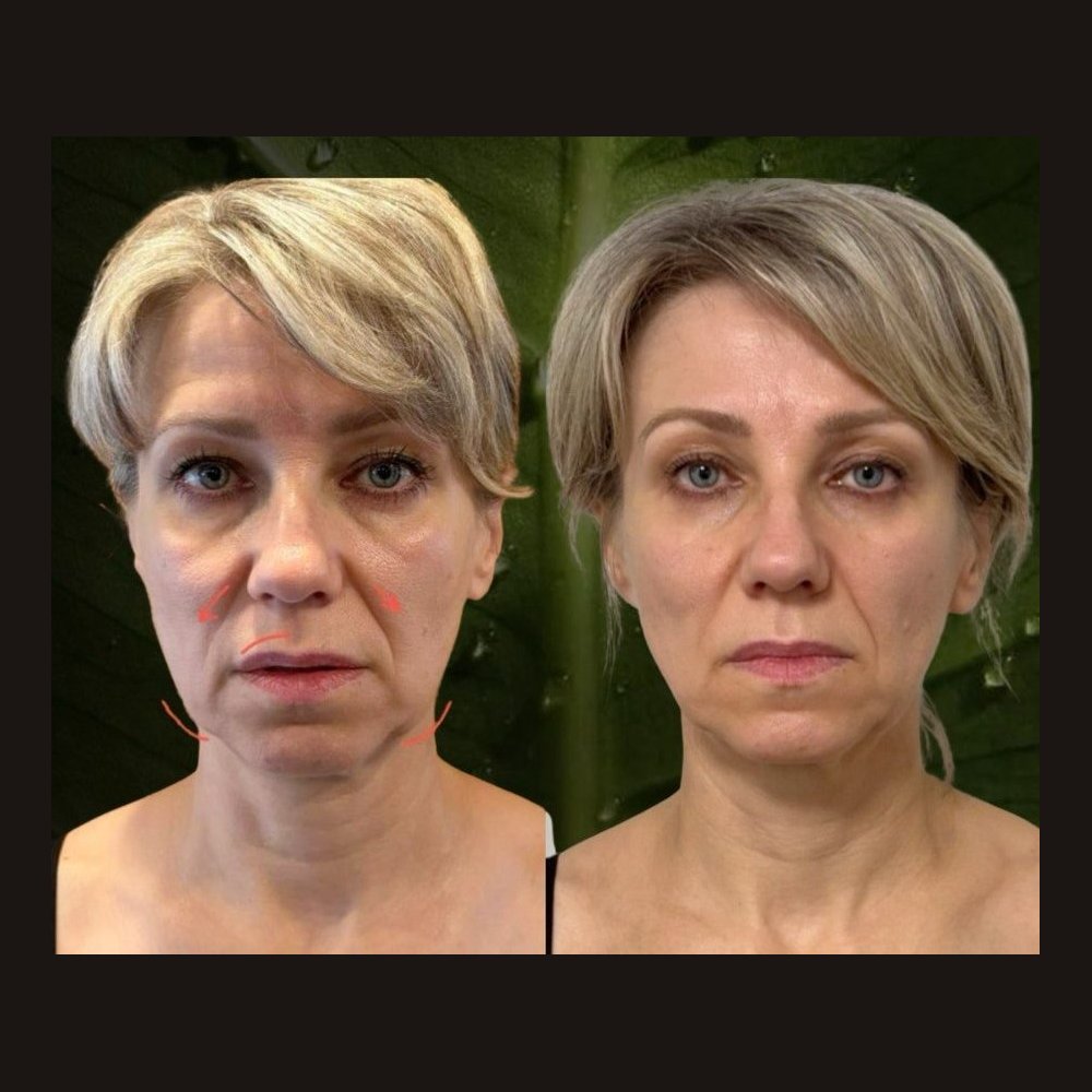 Facial sculpting — before and after a course