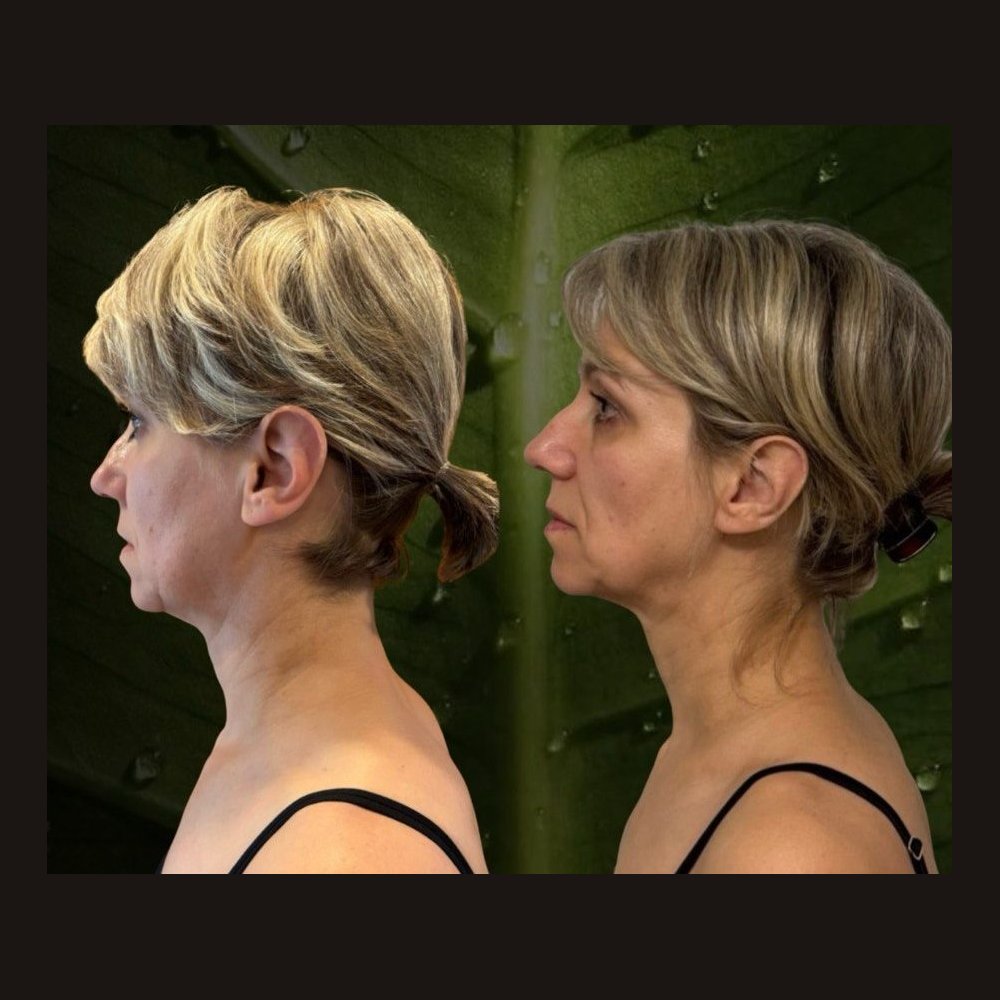 Facial sculpting in profile — before and after a course
