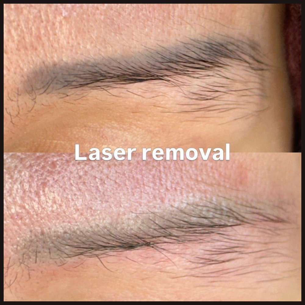 Laser removal of old brow permanent makeup