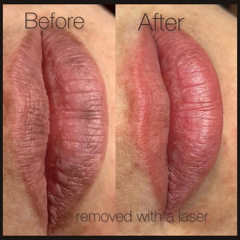 Laser removal of old lip permanent makeup