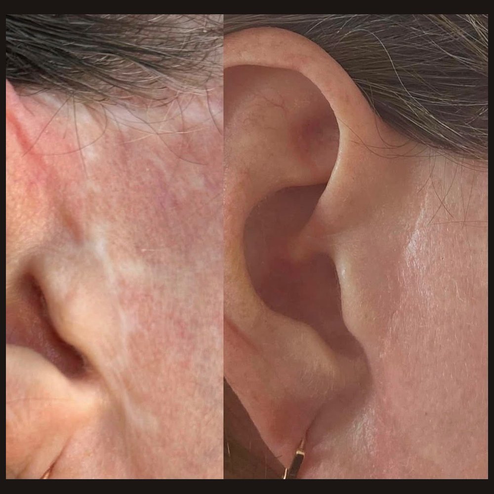 Camouflage of scars after plastic surgery. One session