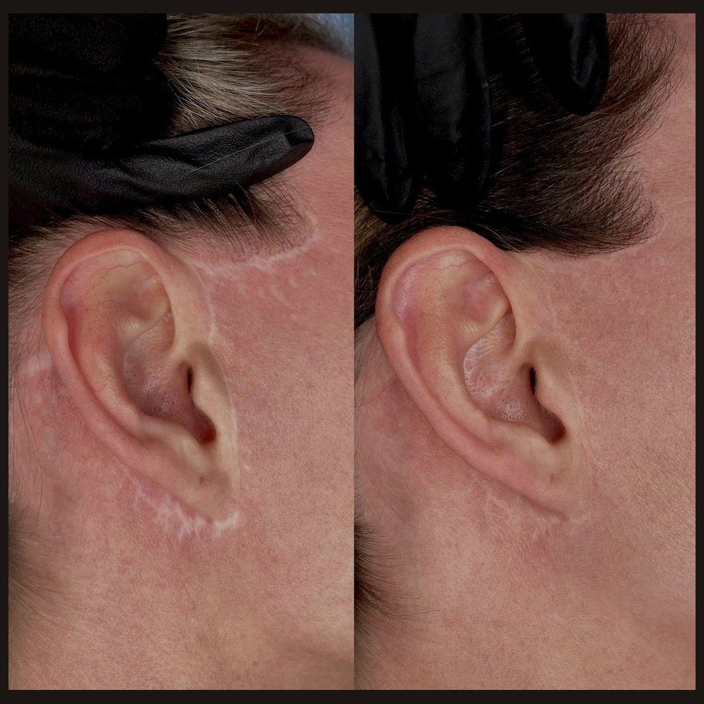 Camouflage of scars after plastic surgery. Two sessions