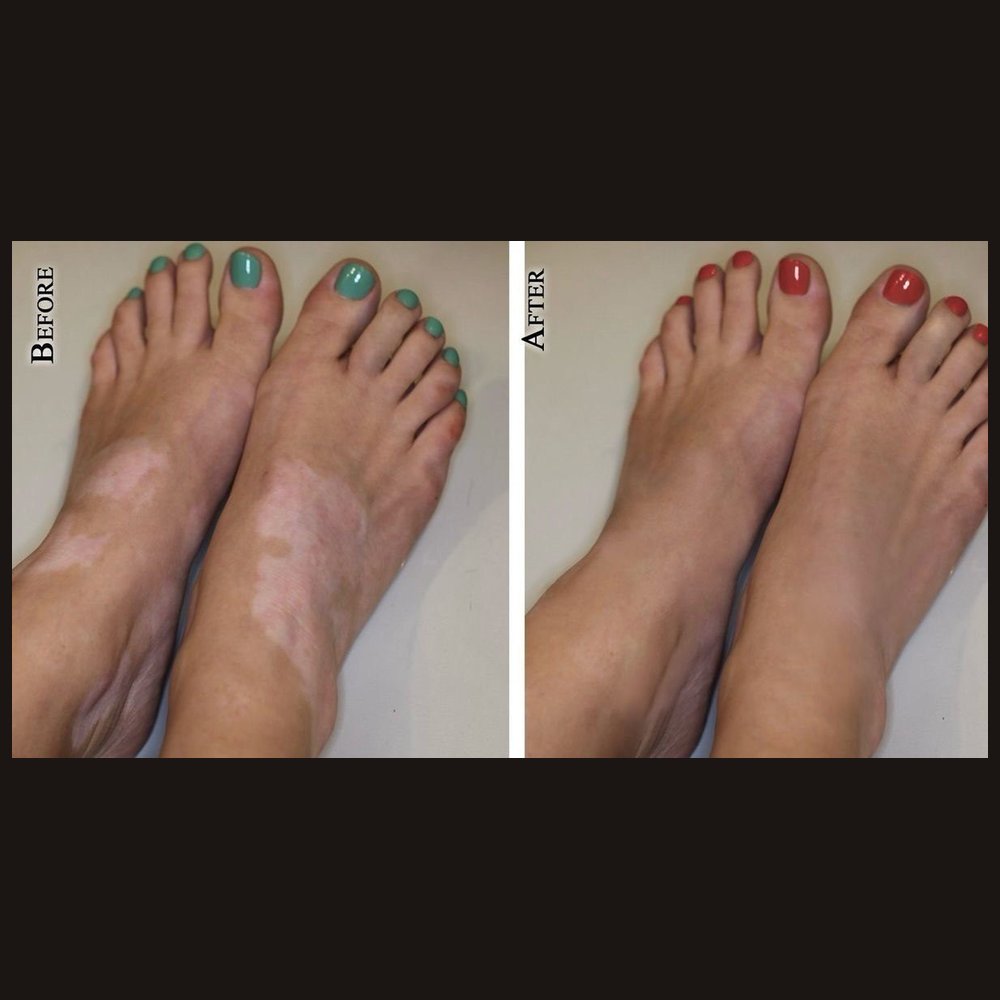 Vitiligo camouflage. Three sessions